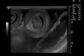 Sonographische Ileusdiagnostik 300x200.jpg