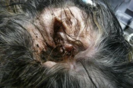 Ear Cleaning - What a nurse should know