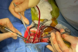 25_08_20_Mitral valve repair surgery- what is important to know from a primary care standpoint?_300x200.png