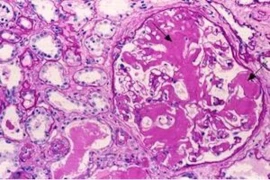 Proteinurie_300x200.jpg