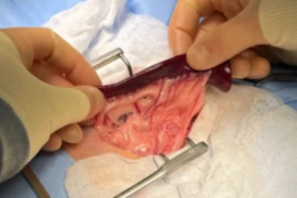 E_25_07_02_Mastering the Basics of Liver and Splenic Surgery_300x200.png