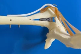 RATO - Rovesti Abduction Trochanteric Osteotomy - Rationale and early clinical results