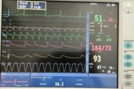 Advanced Mechanical Ventilation