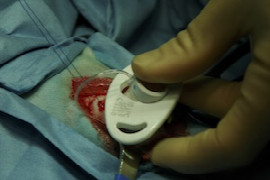 Catheter placement