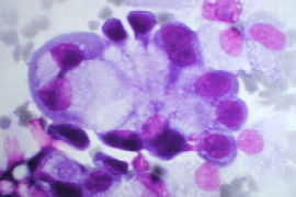 Pitfalls of Cytology