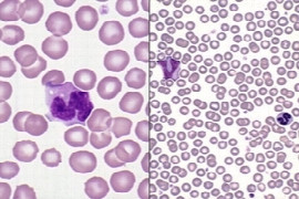 Haematology Case Studies