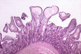 intestinaler-eiweia-verlust-5.jpeg