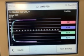 Disseminated intravascular coagulation