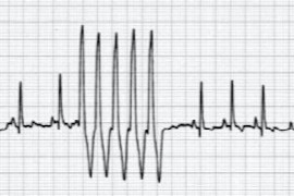 an-introduction-to-ecgs-demystifying-the-electrocardiogram-for-nurses.jpeg