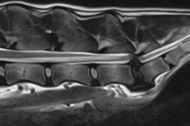 Lumbosacral Stenosis