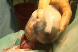 Caesarean Section - tips for success