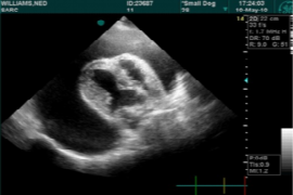 Pericardial effusion