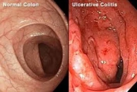 Inflammatory Bowel Disease for Nurses